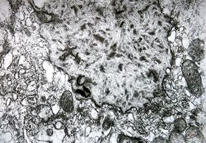 Whipple disease Whipple disease